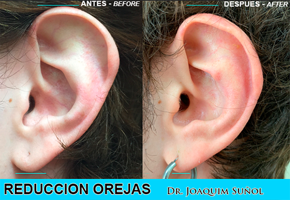 Otoplastia - Orejas - Dr. Joaquim Suñol - Cirugia Estetica
