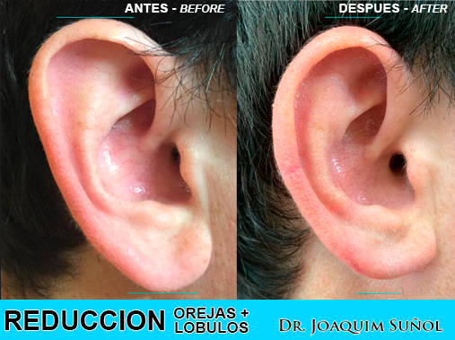Para reducir el tamaño de toda una oreja: lobulos y pabellon auricular