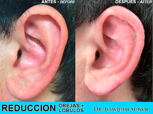Para reducir el tamaño de toda la oreja: lobulos y pabellon auricular