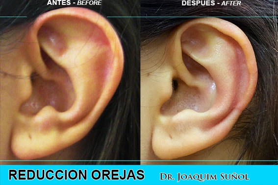 Otoplastia - Orejas - Dr. Joaquim Suñol - Cirugia Estetica