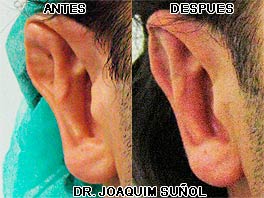 Otoplastia secundaria Dr. Joaquim Suñol - Cirugia Estetica - Barcelona