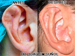 Otoplastia Secundaria Cirugia estetica de las orejas Dr. Joaquim Suñol - Barcelona