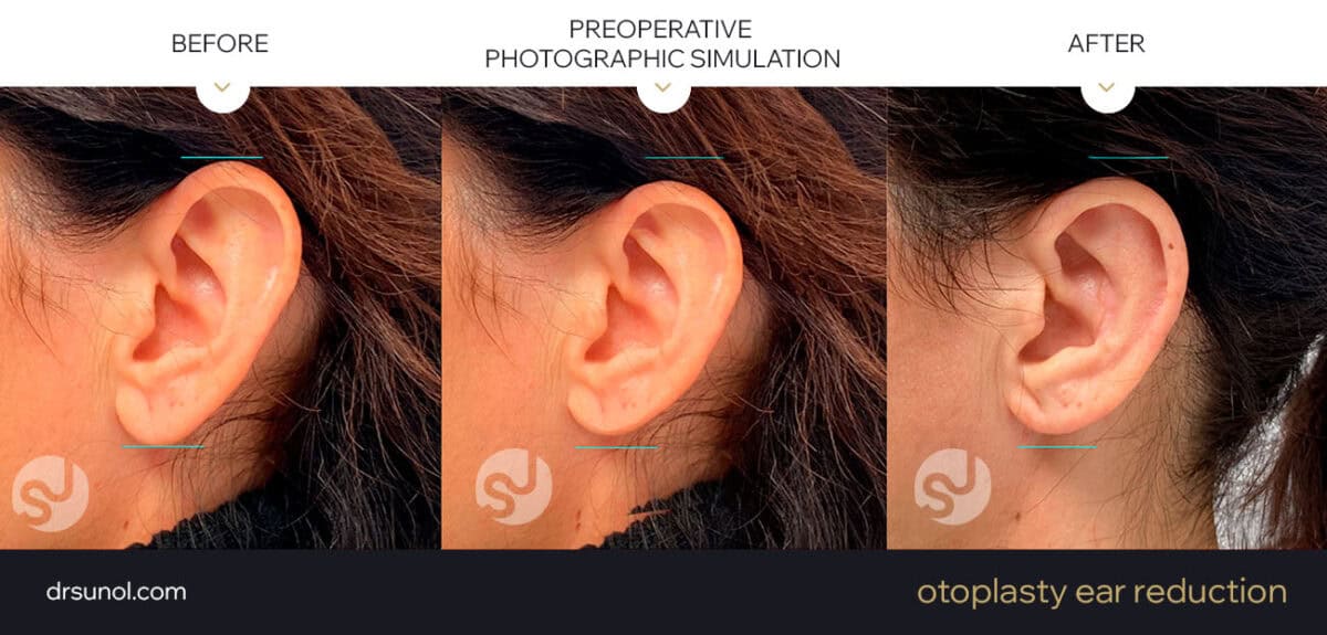 Before and After Ear Reduction – Dr. Joaquim Suñol