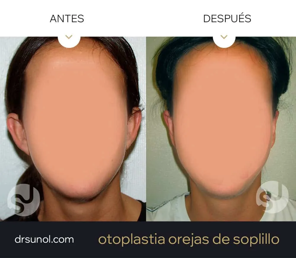 operacion orejas de soplillo antes y después operacion orejas de soplillo antes y después