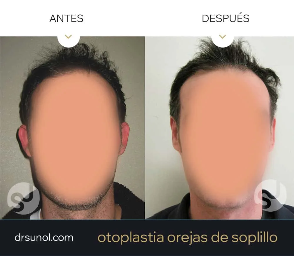 corregir orejas de soplillo antes y después corregir orejas de soplillo antes y después
