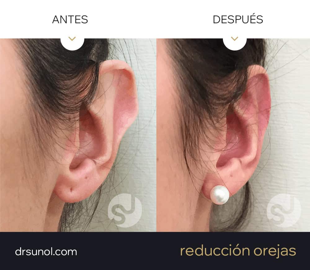 operacion de orejas grandes antes y despues tuberculo darwin - vista izquierda