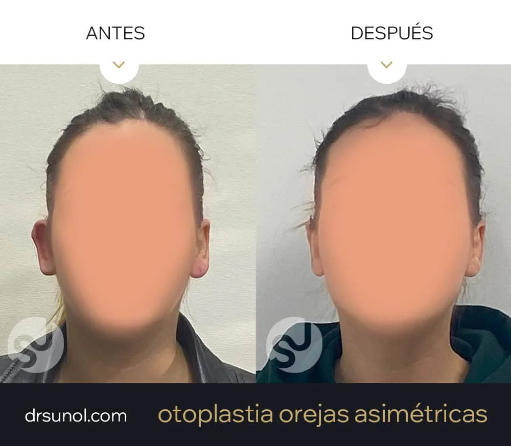 Para mejorar las asimetrias en las orejas diferentes: antes y después