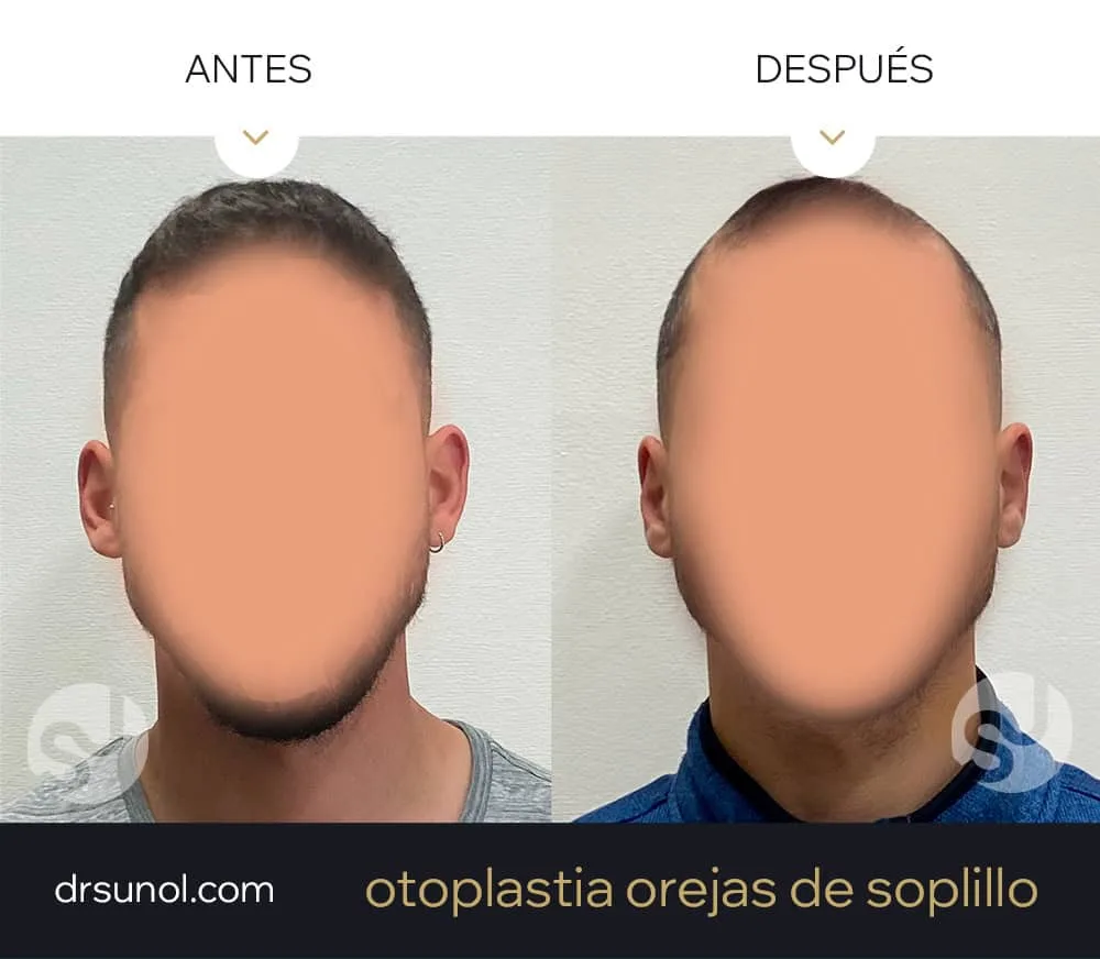 Otoplastia orejas separadas
