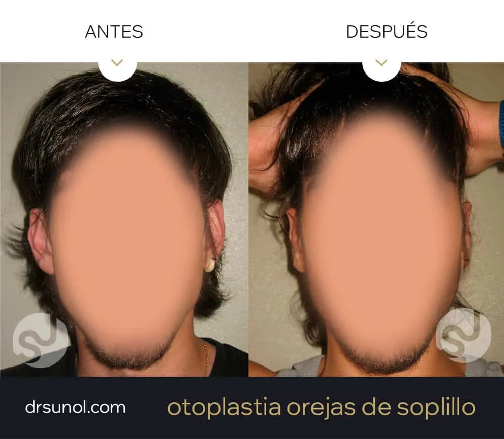orejas soplillo antes y después orejas soplillo antes y después