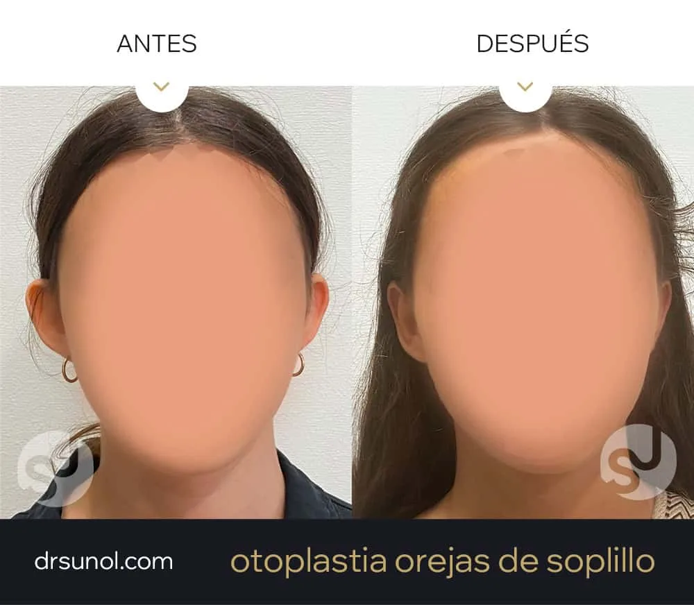 orejas separadas antes y después orejas separadas antes y después