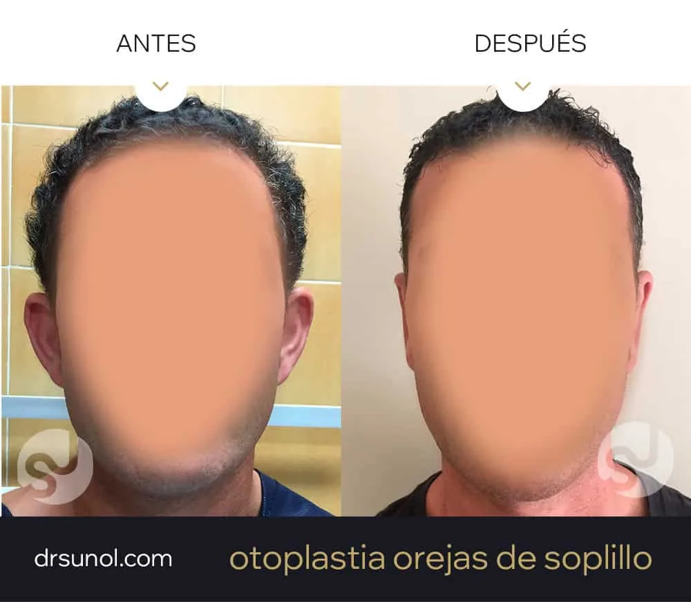 orejas en asa antes y después orejas en asa antes y después