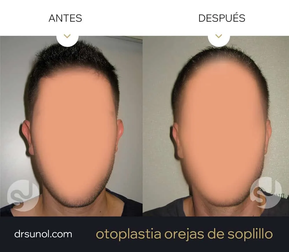 orejas de asa antes y después orejas de asa antes y después