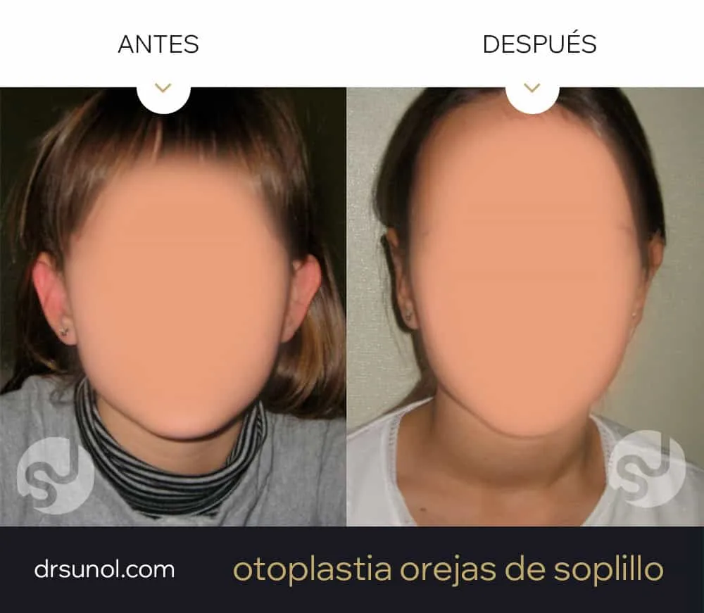 cirugia orejas de soplillo niños antes y después cirugia orejas de soplillo niños antes y después