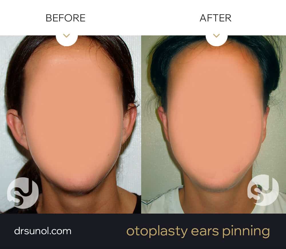 protruding ears before and after