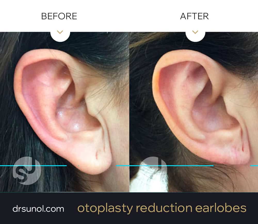 separated ear lobe before and after