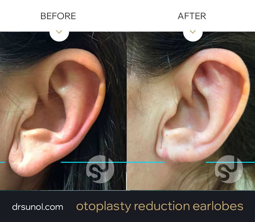 lobe reduction before and after