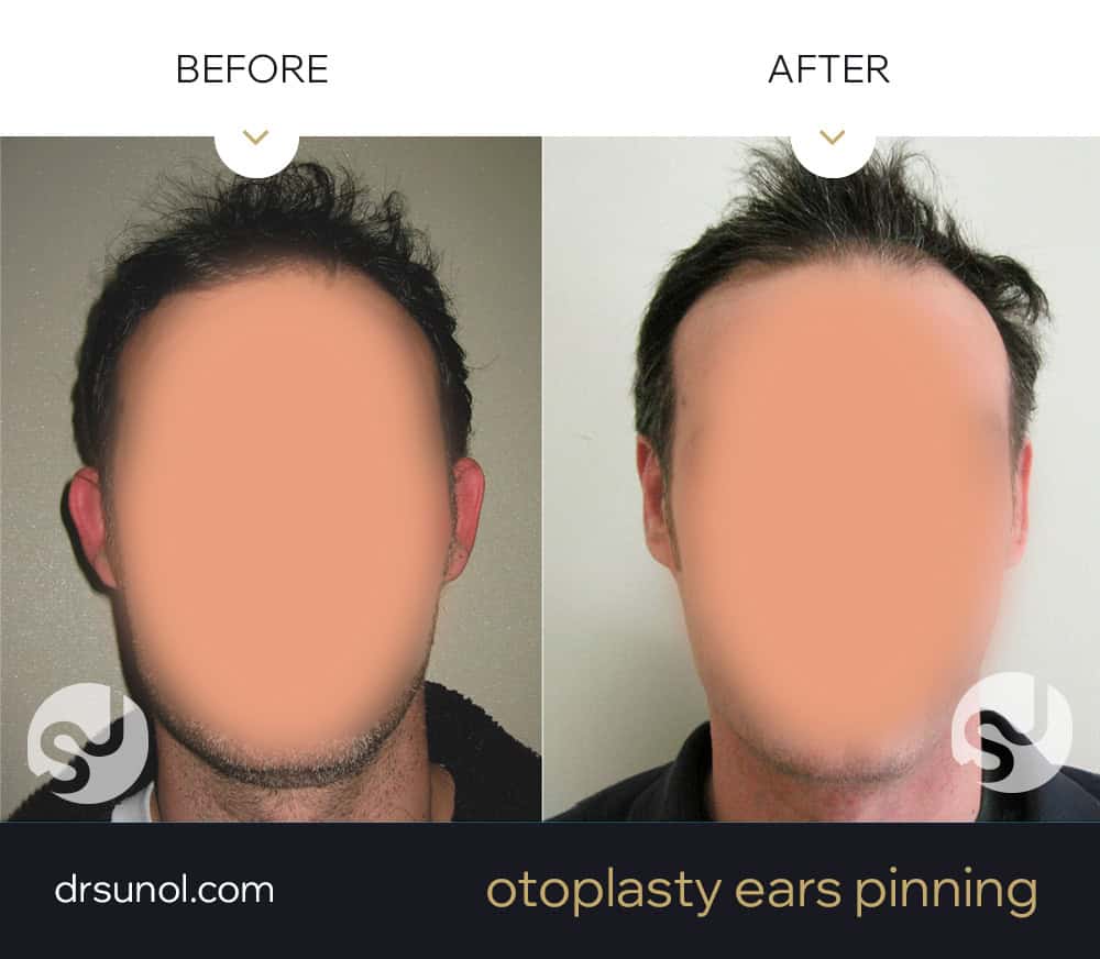 correct protruding ears before and after