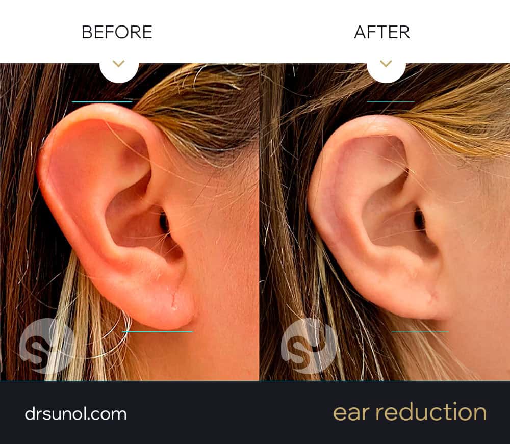 before and after female ear reduction