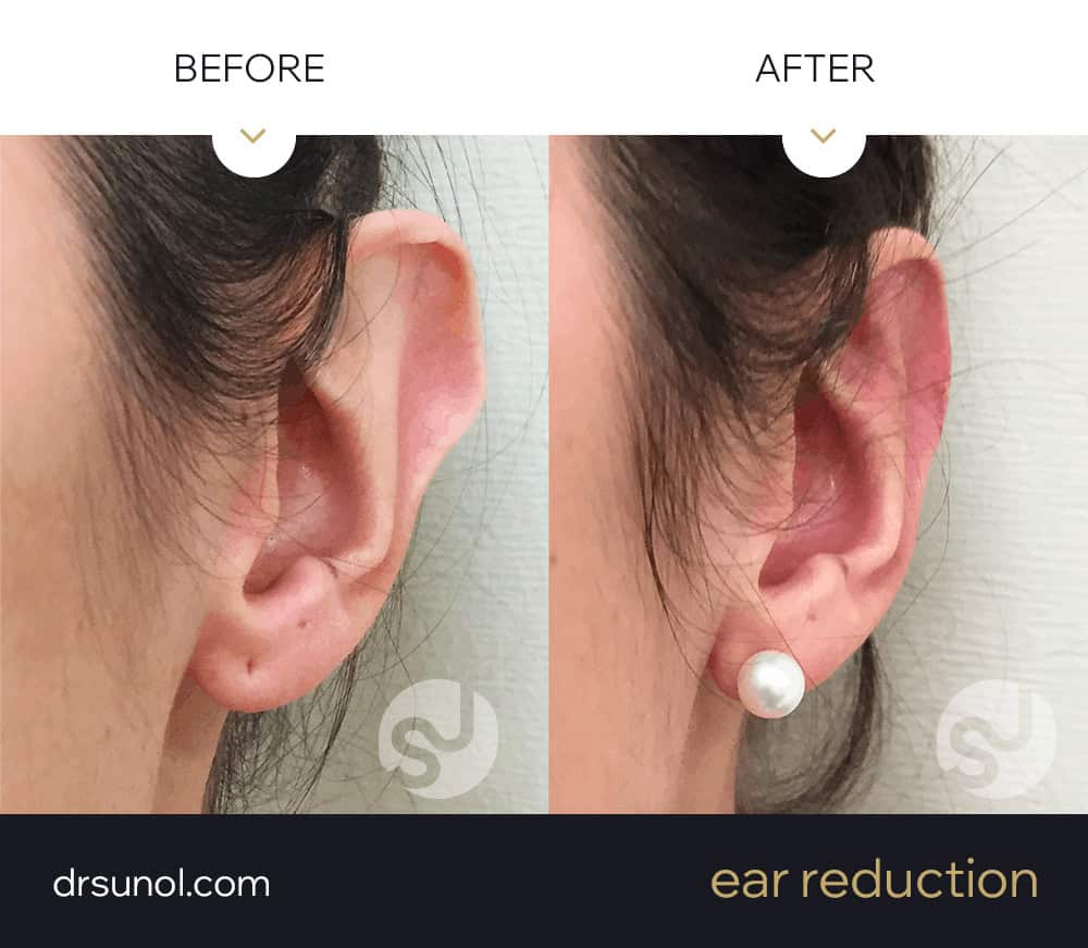 result of ear reduction for women