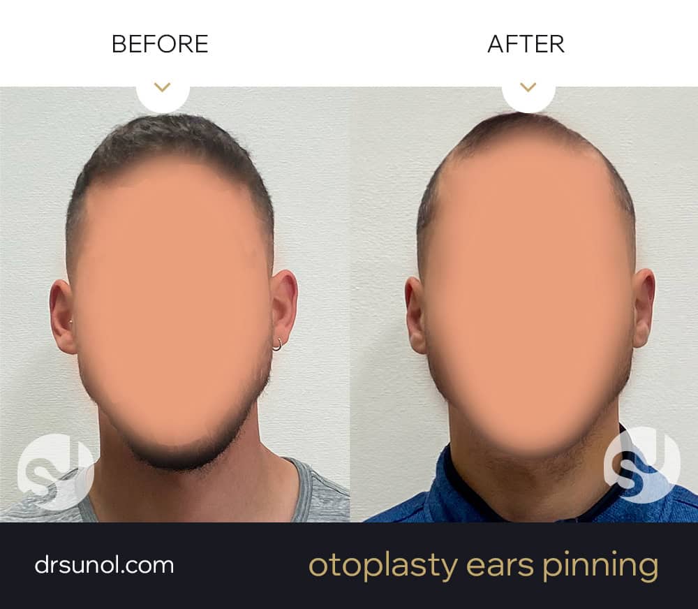 protruding ear surgery before and after