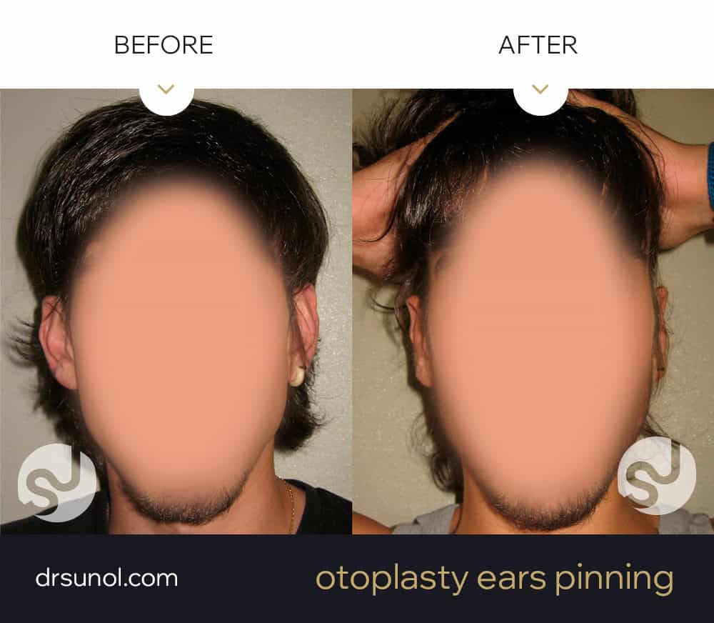 image of protruding ears before and after