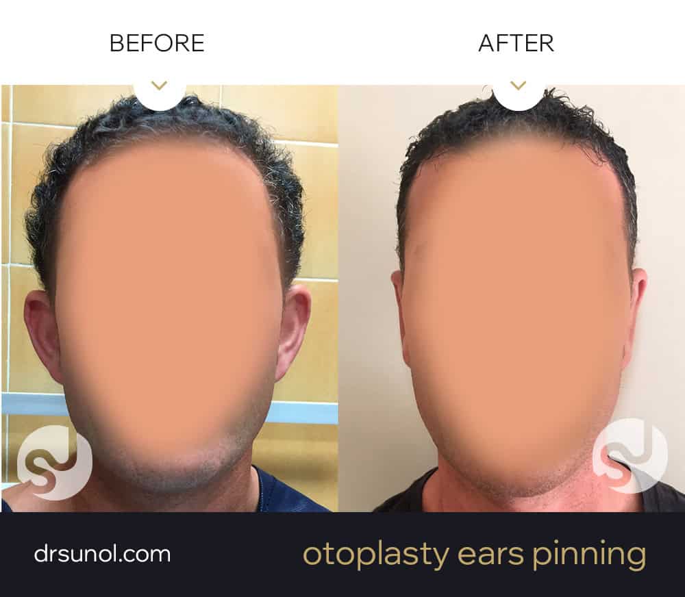 ears in handle before and after