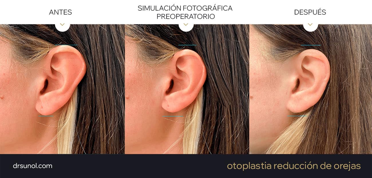 Ejemplo simulación fotográfica operacion de reduccion de orejas y resultados reales