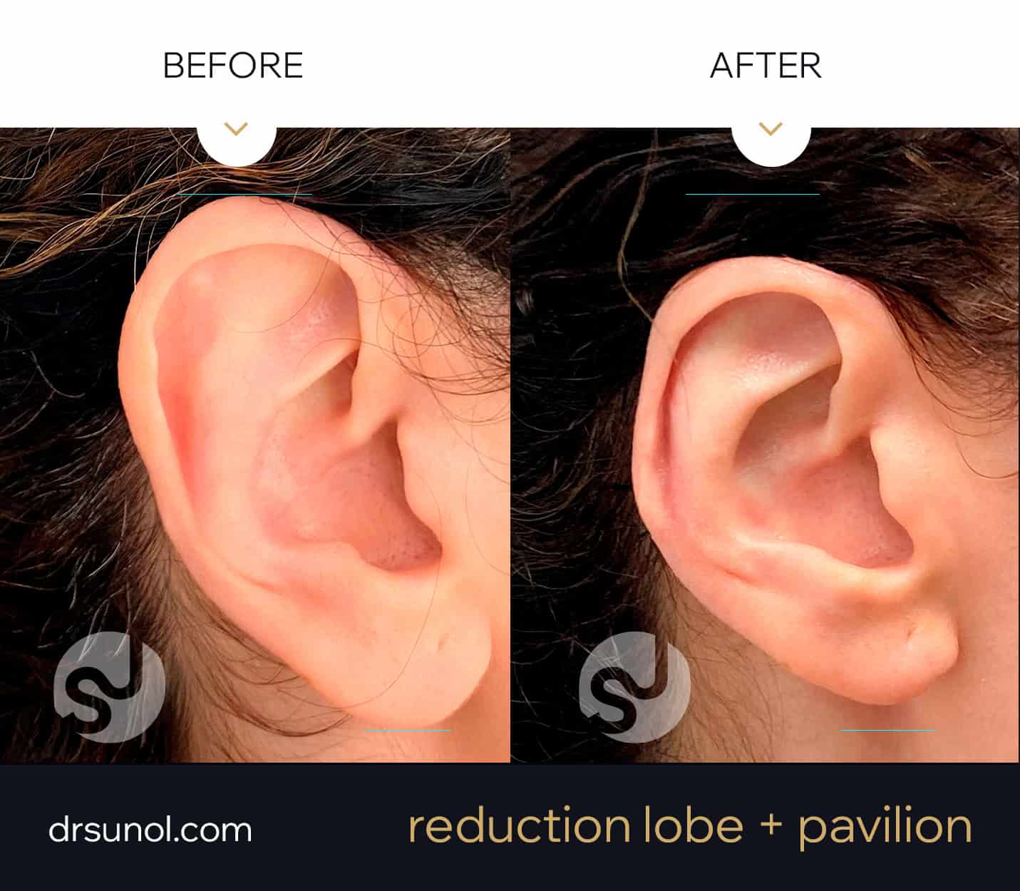 Ear Reduction Surgery before and after - front view