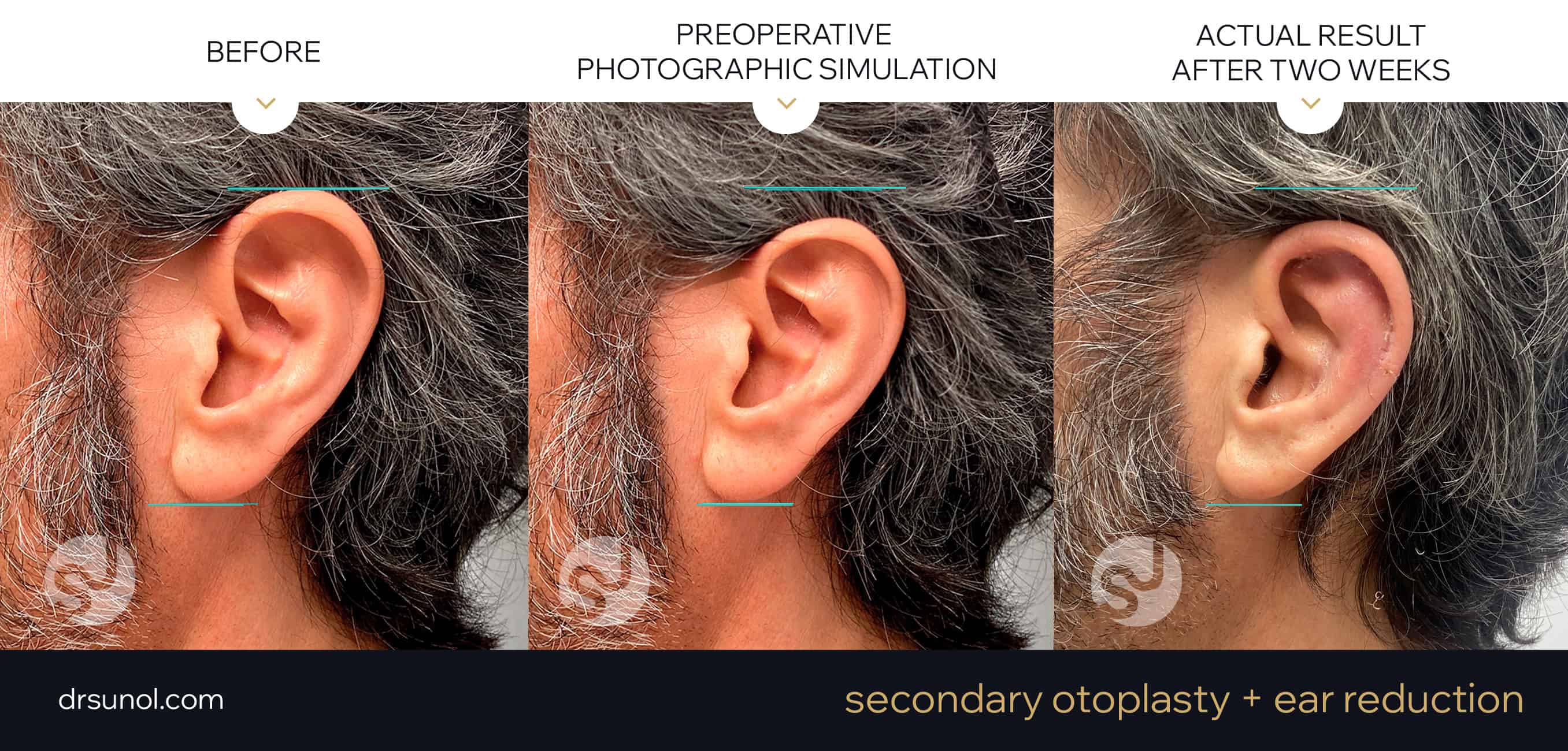 Ear reduction and secondary otoplasty photo simulation and actual results after 2 weeks
