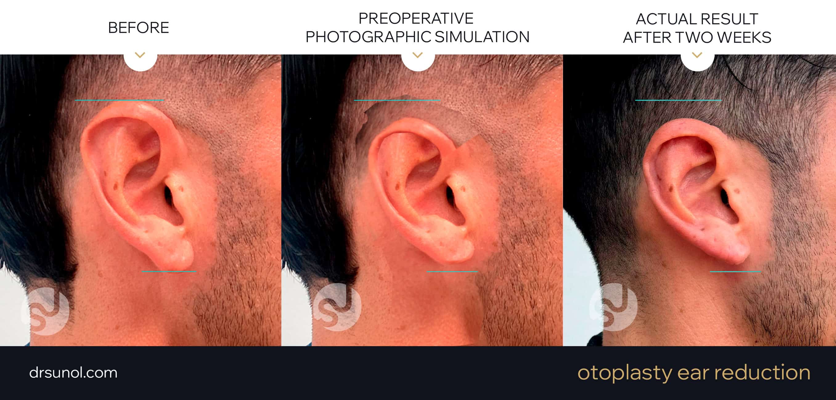 Ear reduction otoplasty photo simulation and actual results