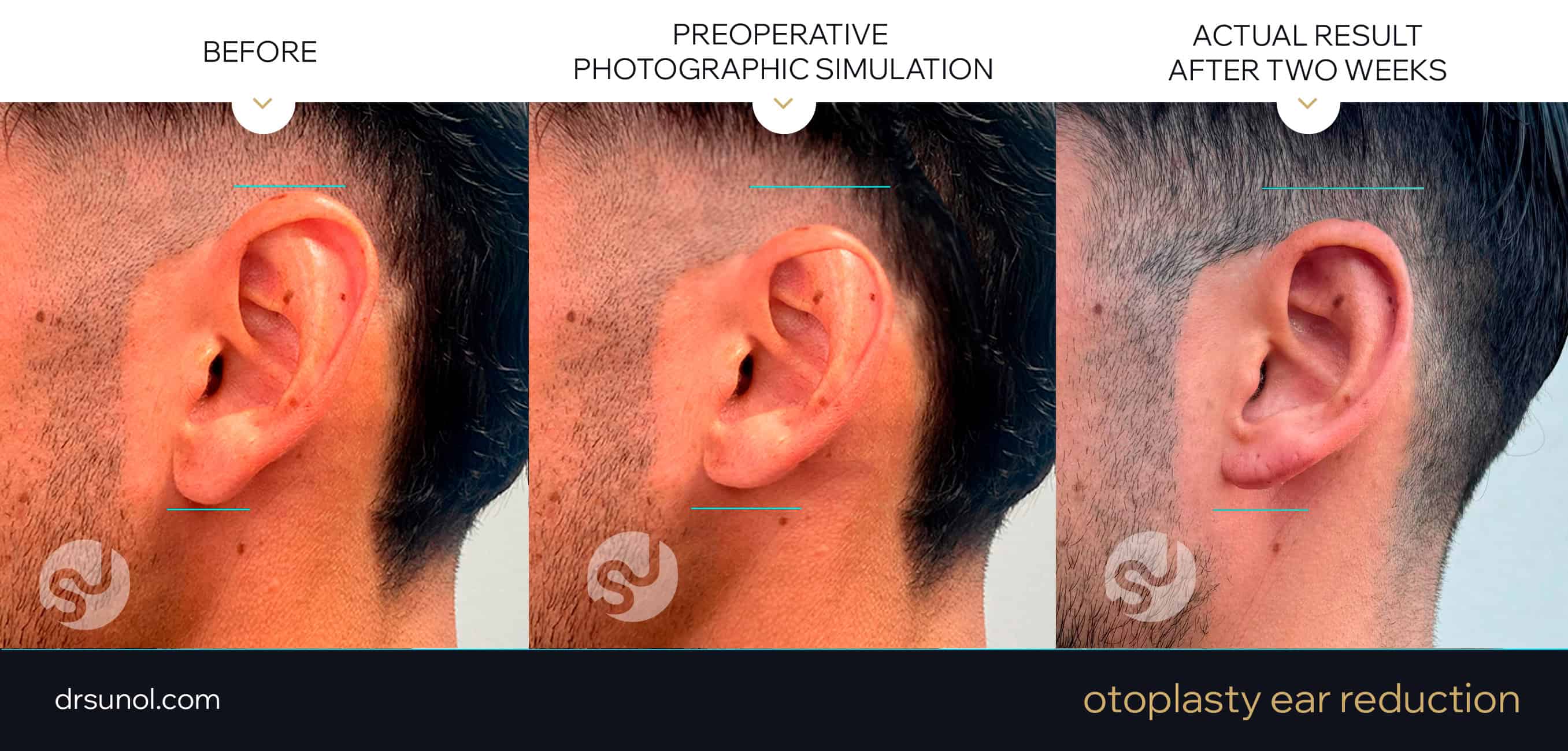 Ear reduction otoplasty photo simulation and actual results