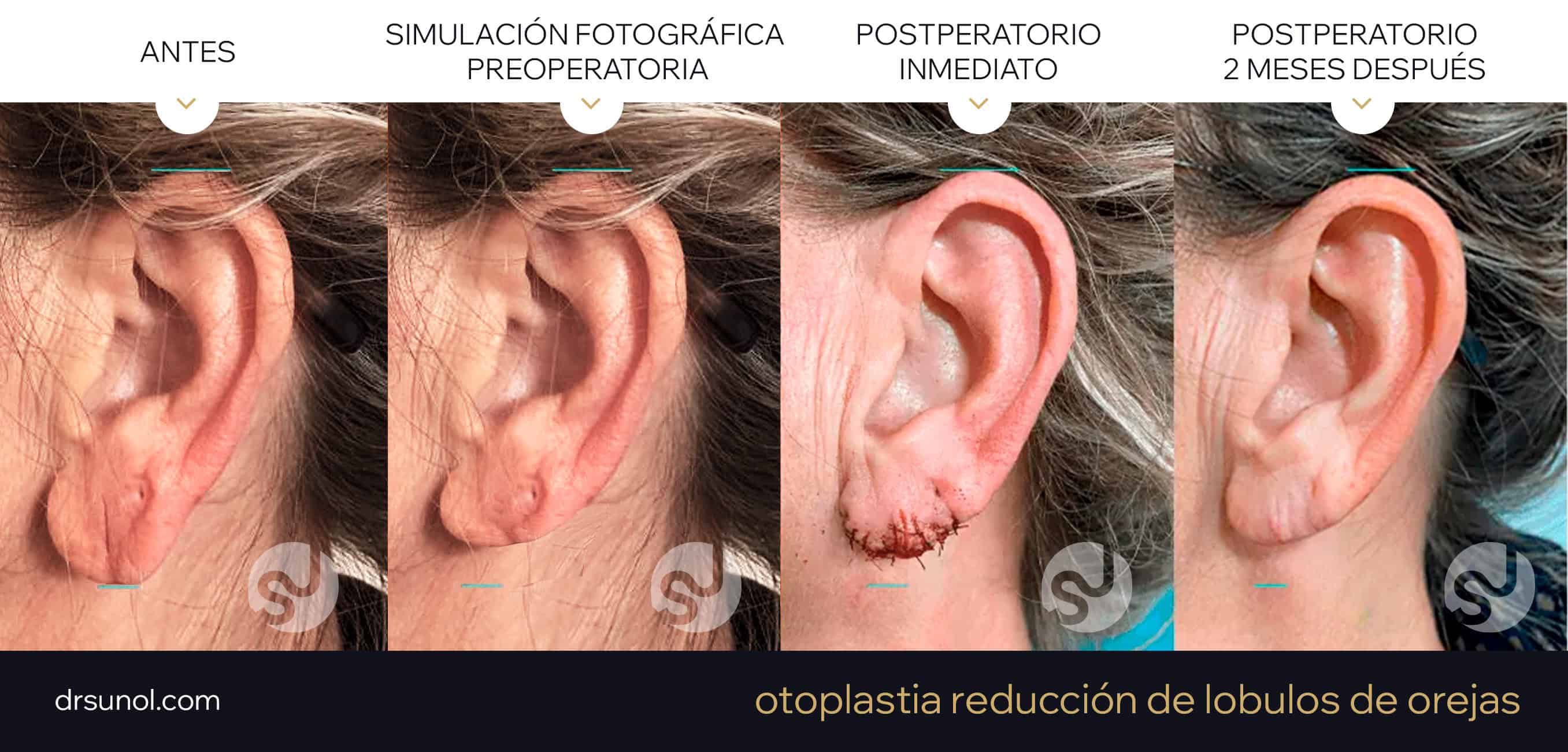 operacion de lobulo de oreja antes y después