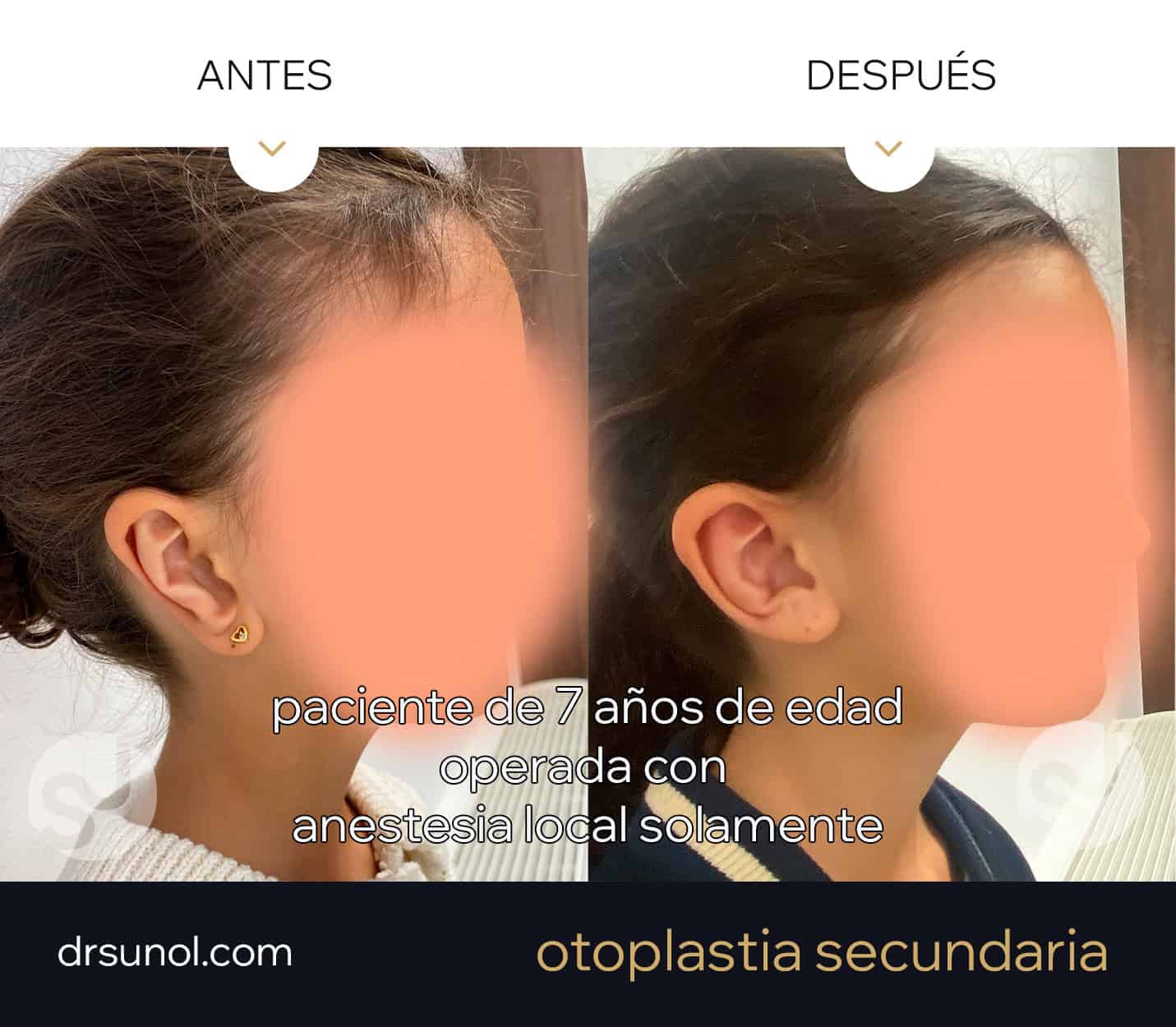 Otoplastia Secundaria en niño pequeño: Antes y Despues