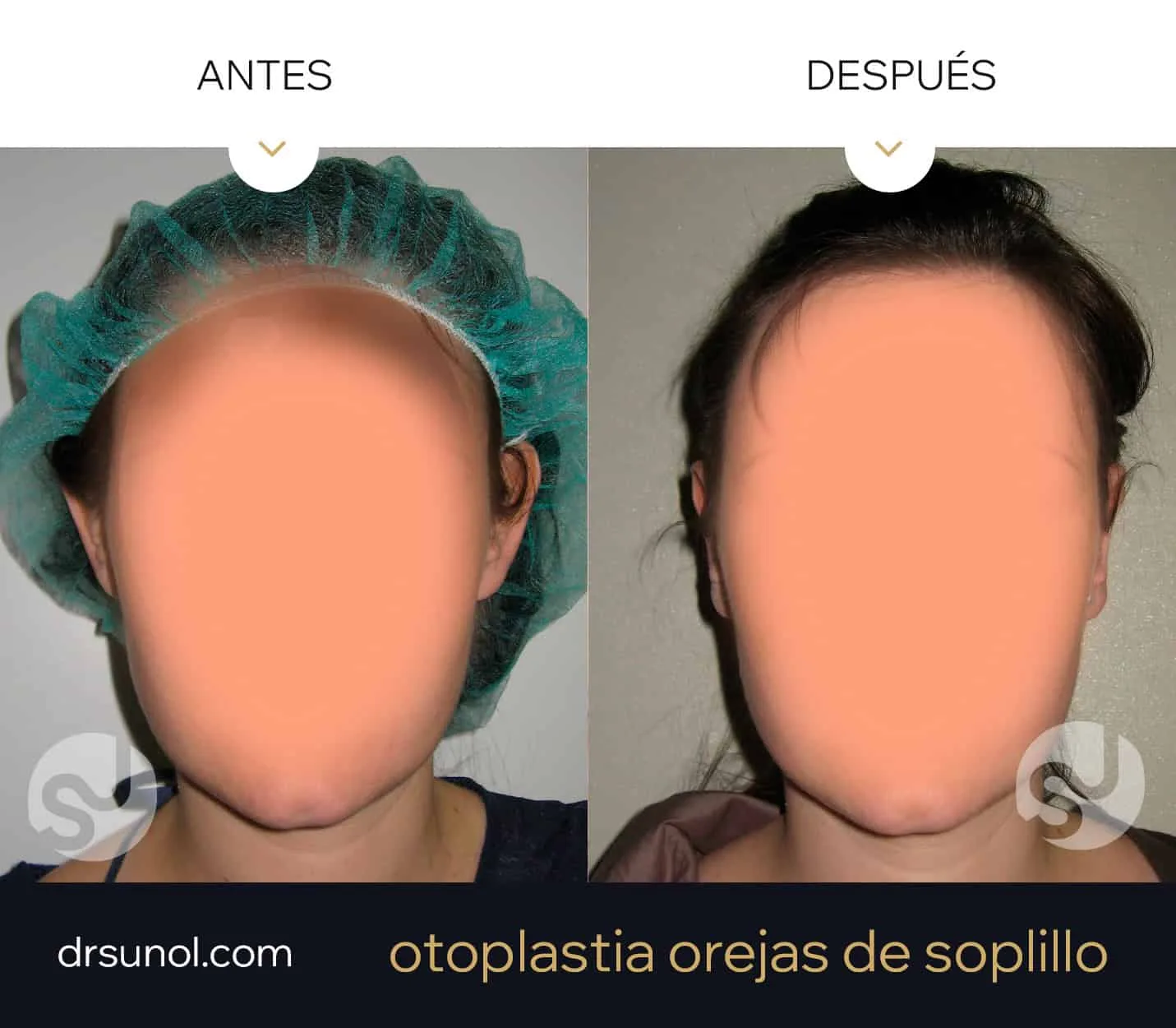 cirugia orejas en asa antes y después cirugia orejas prominentes en soplillo antes y después