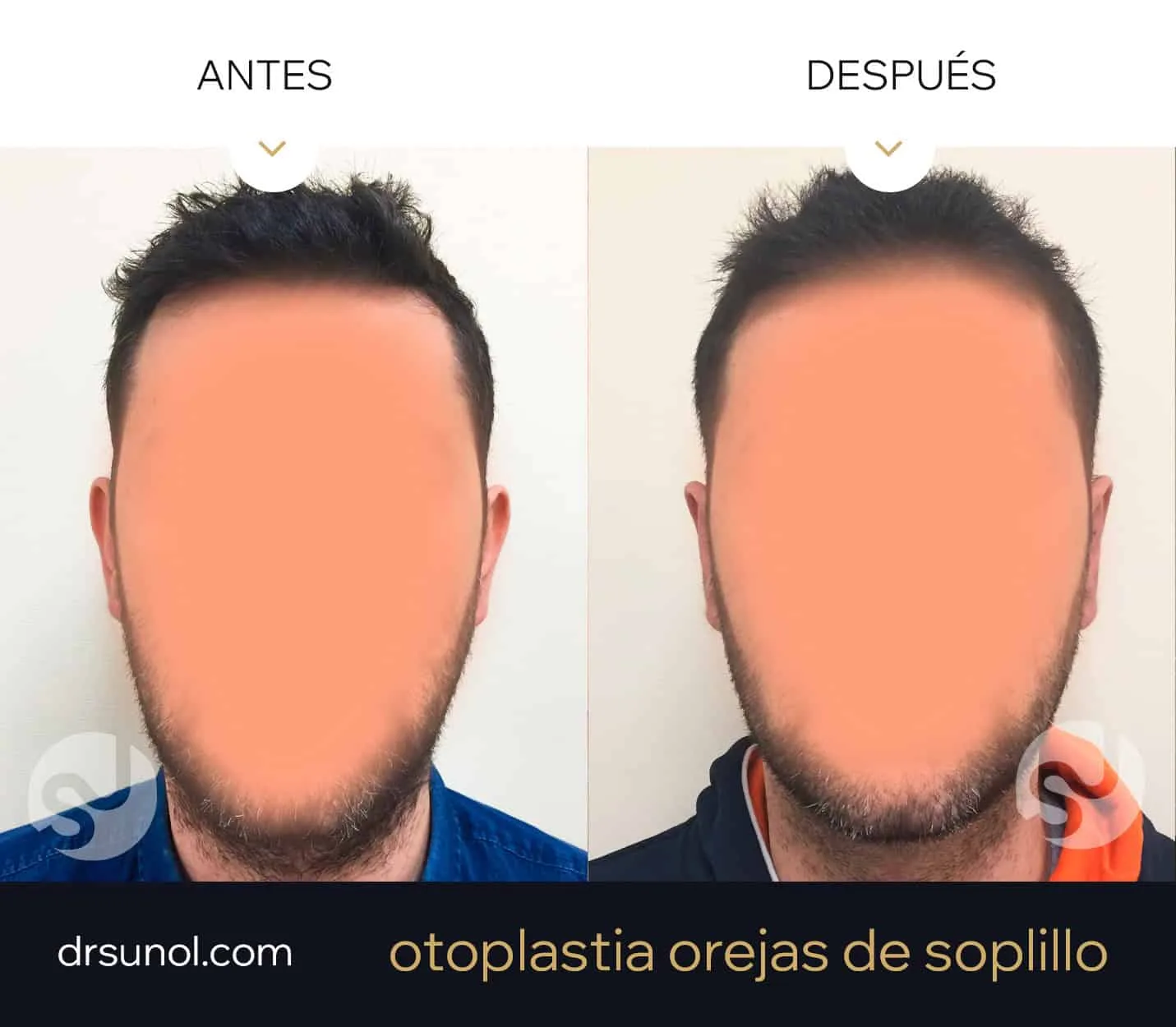cirugia orejas separadas de soplillo antes y después cirugia orejas prominentes en soplillo antes y después