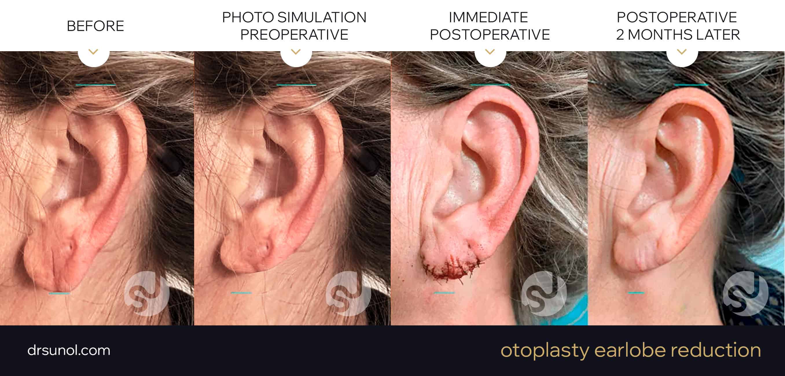 ear lobe operation before and after