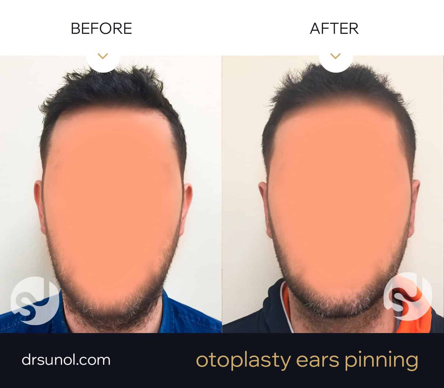 Otoplasty subtle Ear pinning example Otoplasty subtle Ear pinning example