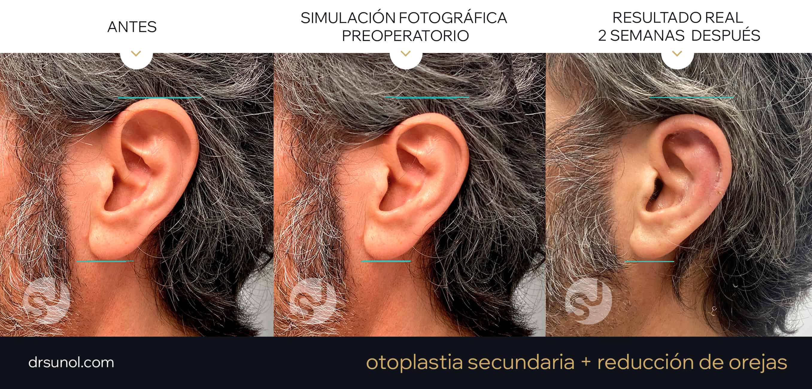 Simulación fotográfica otoplastia reduccion tamaño y resultado real