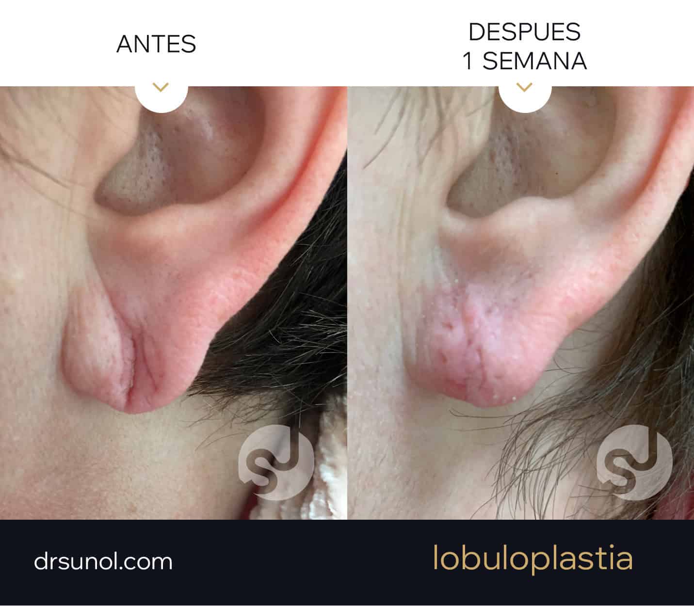 lobuloplastia antes y después