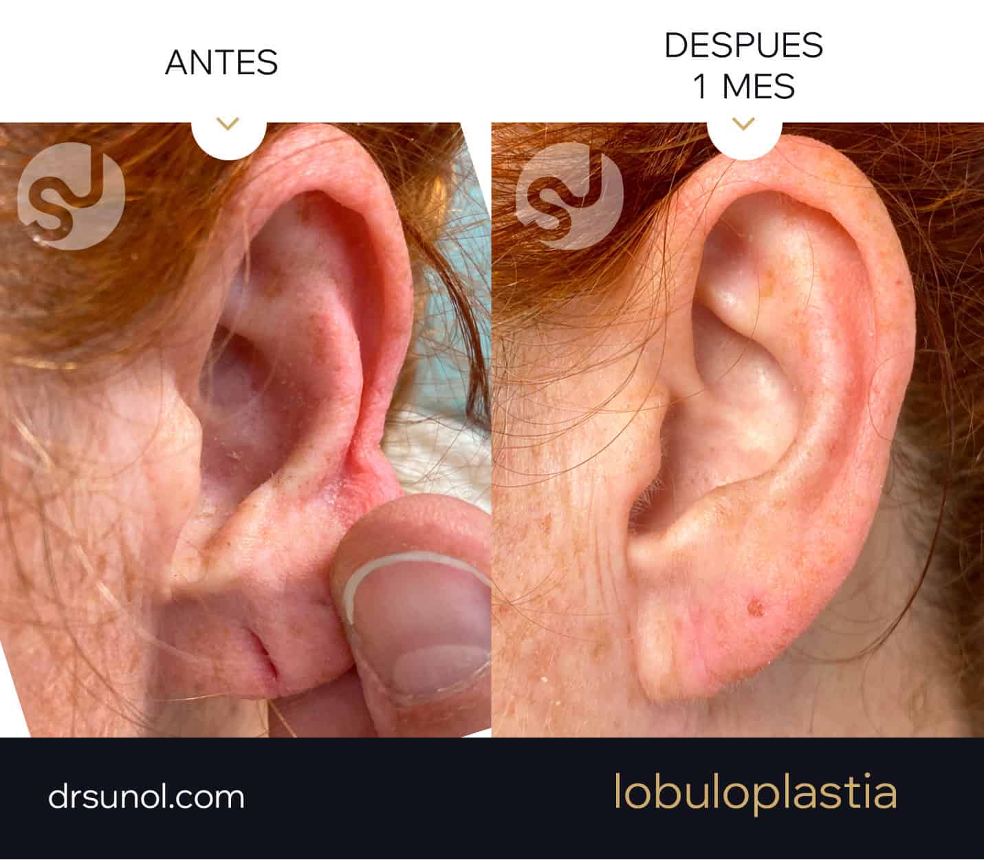 lobuloplastia antes y después
