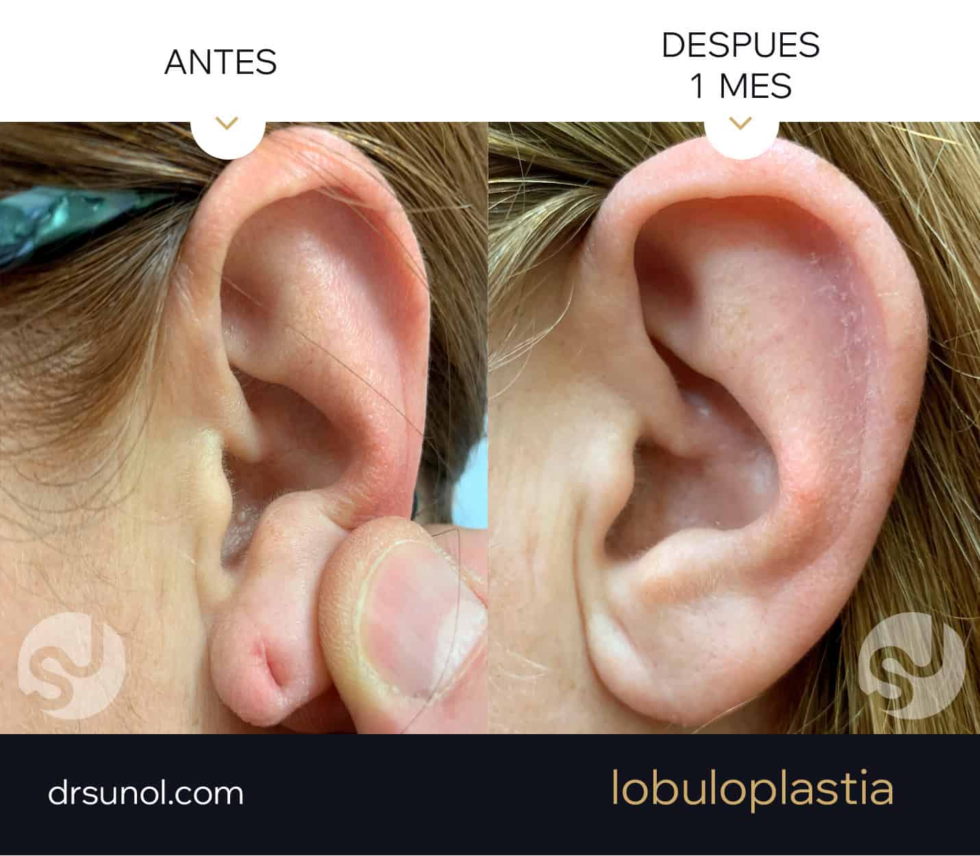 lobuloplastia antes y después