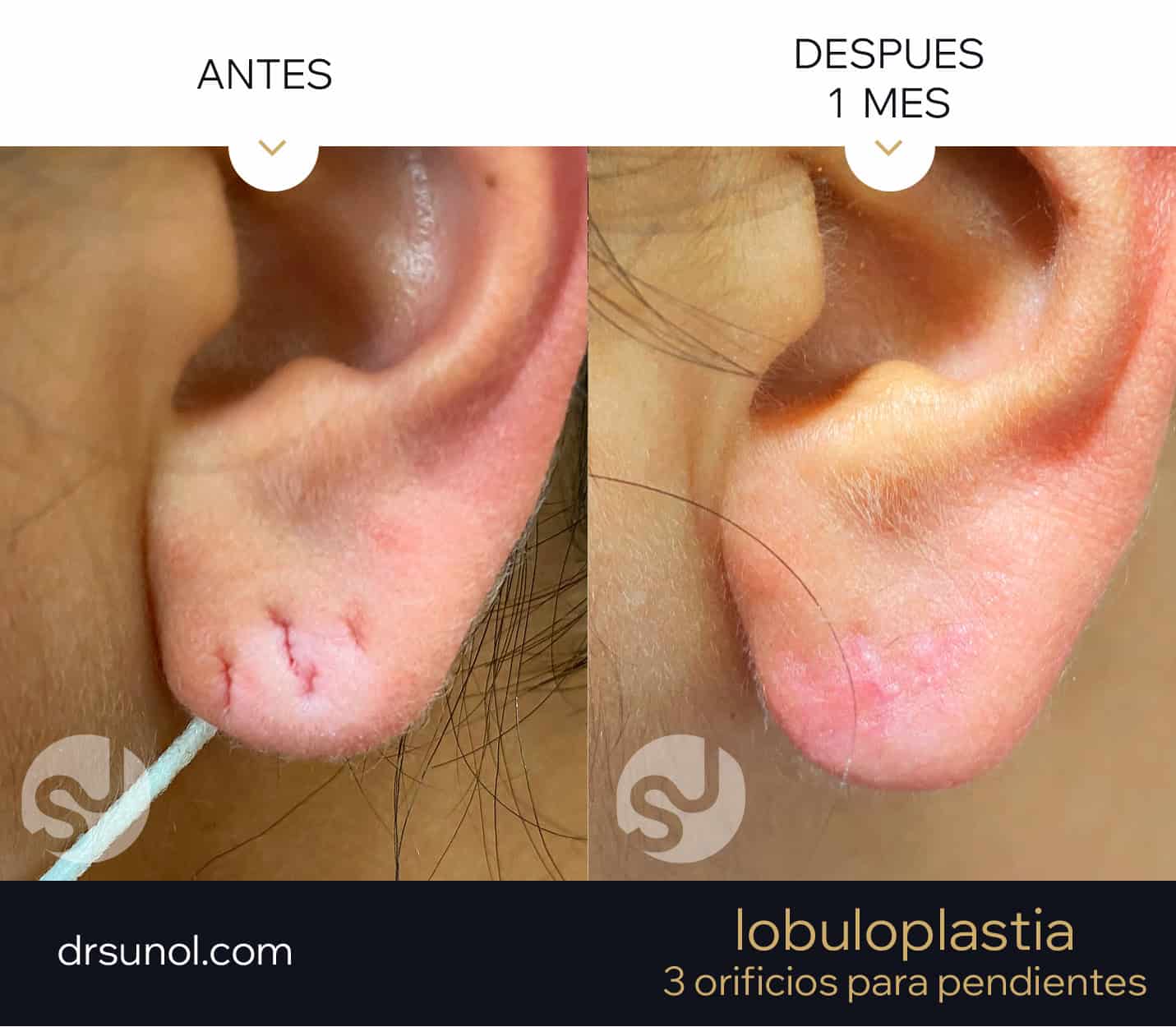 lobuloplastia antes y después