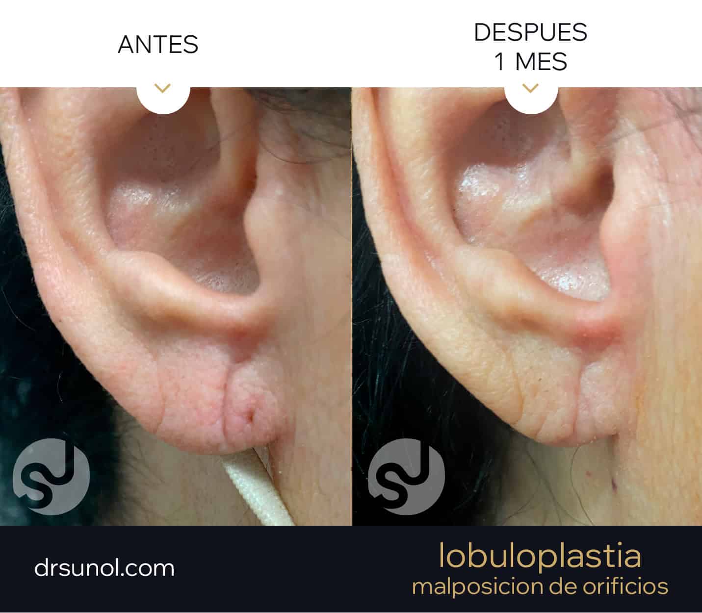 lobuloplastia antes y después