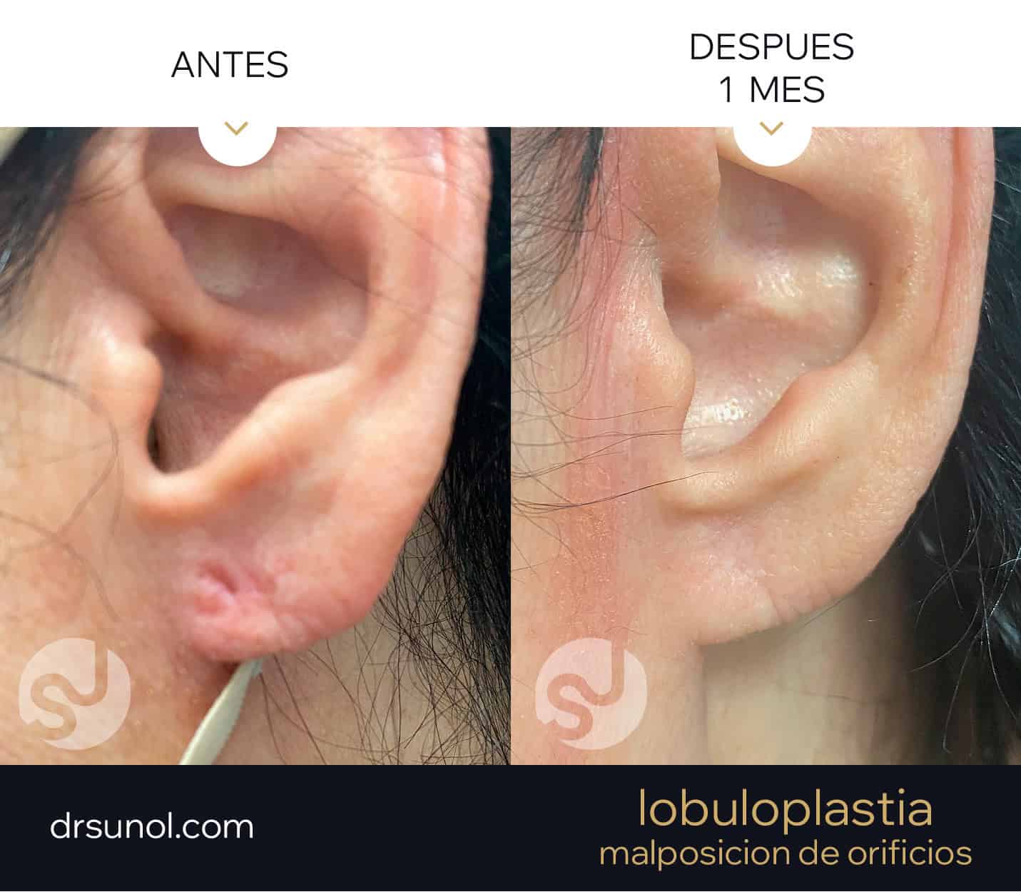 lobuloplastia antes y después