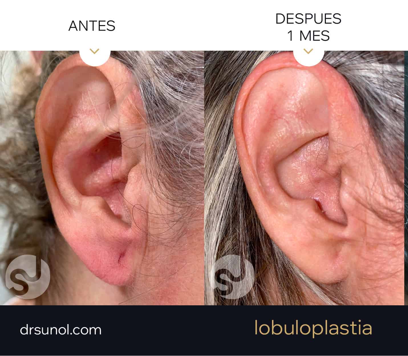 lobuloplastia antes y después