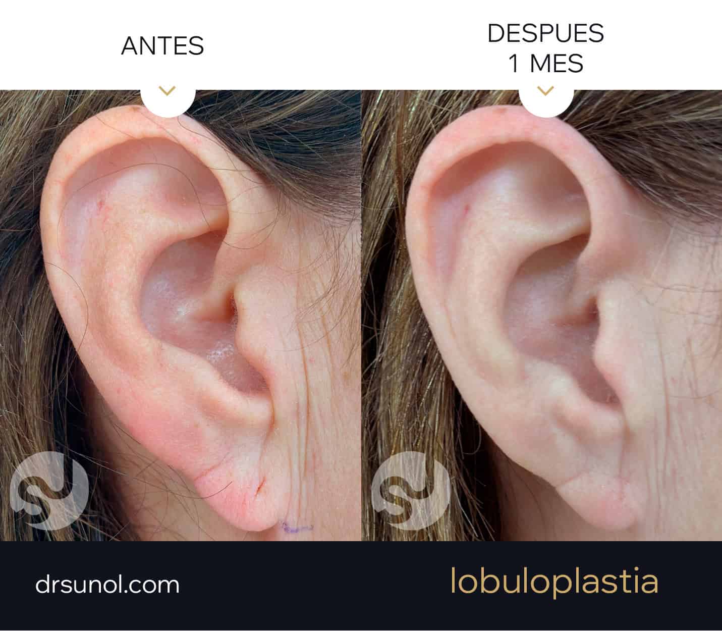 lobuloplastia antes y después