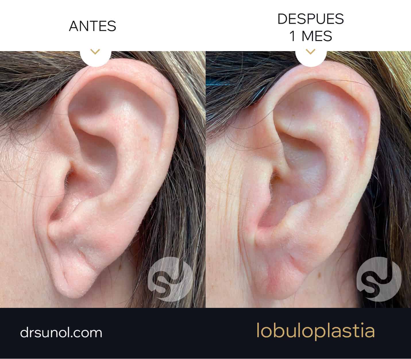 lobuloplastia antes y después