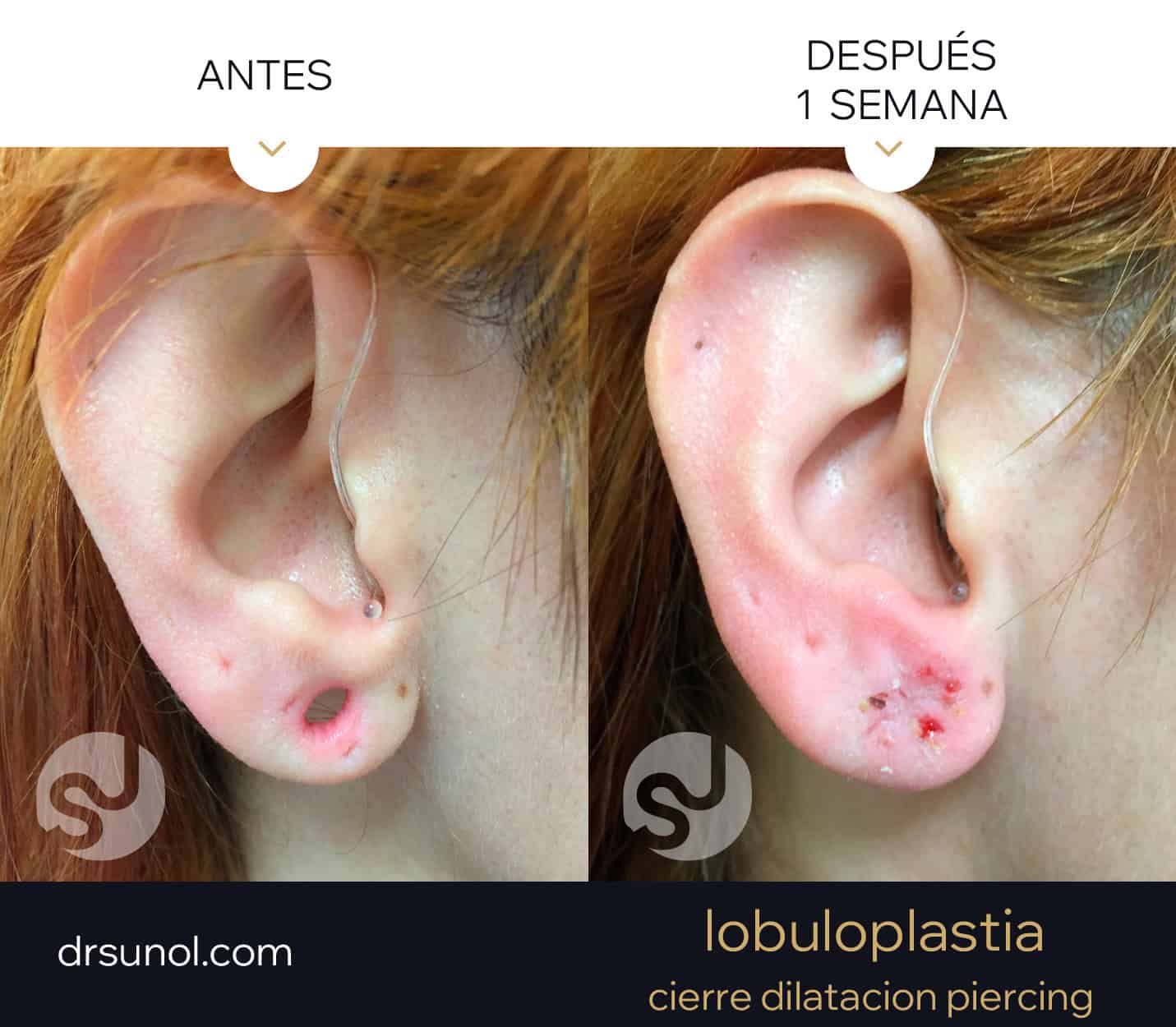 lobuloplastia antes y después