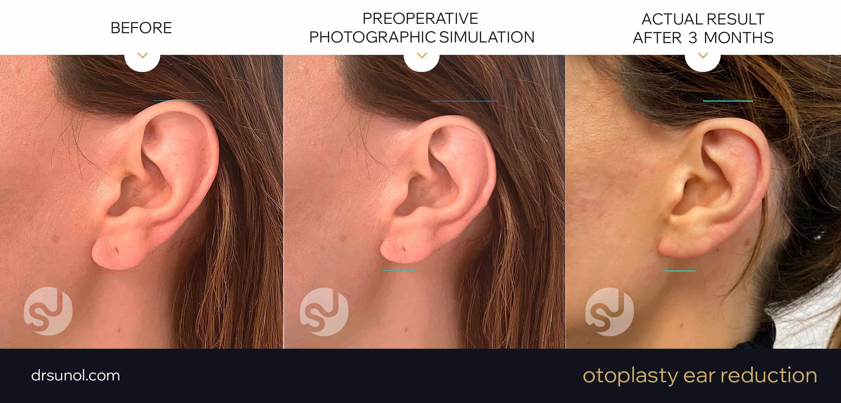 Virtual simulation otoplasty size reduction and final result after 3 months