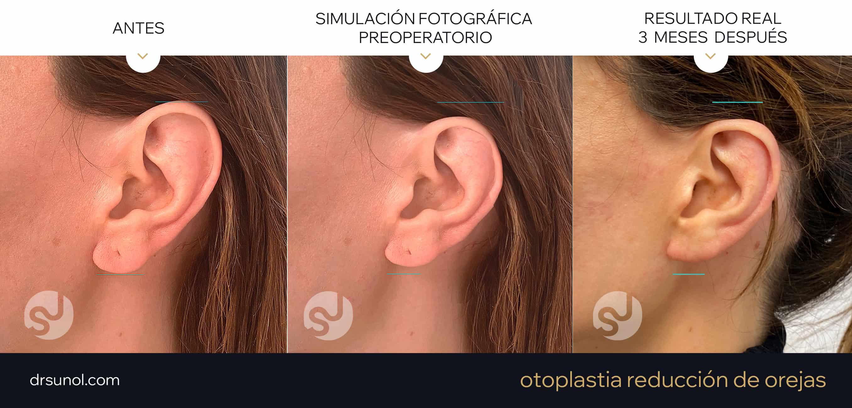 Ejemplo de reduccion de orejas